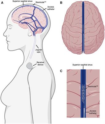 Concept for intrathecal delivery of brain recording and stimulation device